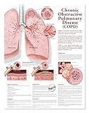 Chronic Obstructive Pulmonary Disease Anatomical Chart